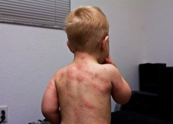 Niño enfermo con sarampión en Estados Unidos. Foto: newsweekespanol.com