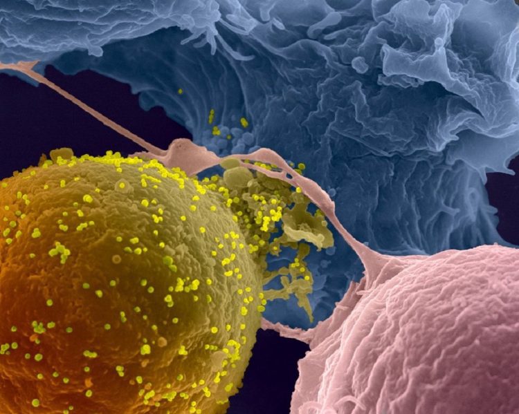 Linfocito infectado por VIH-1 (pseudo-amarillo) en contacto con linfocitos no infectados (azul y rosa). Las partículas virales están en amarillo claro. Foto: Instituto Pasteur
